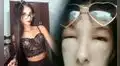 “Me sentí como un monstruo”: joven sufre fuerte reacción alérgica tras aplicarse tinte capilar