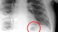 Creyó que una mancha en sus pulmones era cáncer, pero se llevó tremenda sorpresa al descubrir la verdad [FOTO]