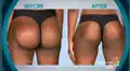 Mujer gastó 4 mil dólares por implantes de glúteos, pero el resultado fue desastroso [FOTOS]
