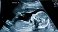 Youtube: bebé de 28 semanas “saluda” a sus padres en una ecografía