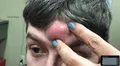 En YouTube, repugnante video de doctora que retiró espinilla gigante