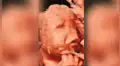Publican primera foto de Rodrigo “el bebé sin rostro” que nació en Portugal