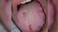 COVID-19: pacientes presentan lesiones en lengua y manchas en la piel