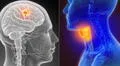Nuevo tratamiento destruye tumores del cáncer de cabeza y cuello, según estudio 