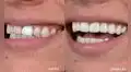 Carillas dentales tipo lentes de contacto: alternativa de tratamiento estético