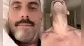 “Soy una persona diferente luego de tener viruela del mono”: el duro relato de pacientes de EE. UU.