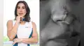 ‘Dra. Fit’ fue denunciada por aplicar metacrilato a sus pacientes, una sustancia que las dejó deformadas  