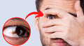 ¿Por qué aparecen lunares en los ojos, qué significan y cuándo deben ser eliminados?