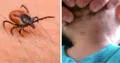 Niño de 4 años muere tras contraer enfermedad letal por picadura de garrapata en México