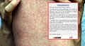 Minsa emite alerta epidemiológica por caso importado de sarampión desde Estados Unidos