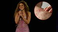 Nueva Jersey lanza alerta sanitaria tras un posible contagio masivo de sarampión en concierto de Shakira