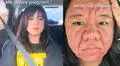 Mujer expone cambio extremo en su rostro durante su embarazo y cómo afectó su autoestima: "No me reconocía"