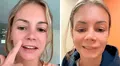 Mujer de EEUU se revienta un grano en el rostro, se infecta de bacterias y por poco pierde la vida