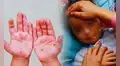 Alerta en el norte del Perú por brote de virus Coxsackie: reportan más de 30 casos de la infección viral "mano, pie y boca"