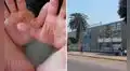 Suspenden clases presenciales en colegio de Lince por contagio de virus Coxsackie que afecta manos, pies y boca en alumnos