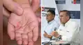 ¿Cerrarán colegios por virus Coxsackie? Esto dijo el Minedu ante el aumento de contagios en Lima y regiones