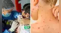 Gobierno declara emergencia sanitaria por brote de sarampión: Lima, Callao y 12 regiones más en alerta