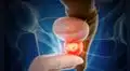 Ensayo clínico internacional demuestra eficacia de terapia combinada en cáncer de próstata agresivo: menos progresión y menor mortalidad