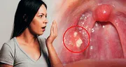 ¿Por qué me salen bolitas amarillas en la garganta y cómo puedo eliminarlas para no tener mal aliento?