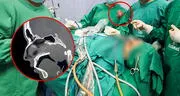Sin abrir el cráneo, médicos de La Libertad extraen tumor nasal gigante a adolescente de 17 años