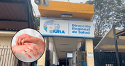 Lepra en Piura: Dirección Regional de Salud reporta el primer caso del 2025