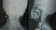 Mujer de 85 años comió un anillo mientras dormía: soñó que era caramelo y terminó internada en hospital de Lima
