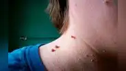 ¿Qué son y cómo quitar los lunares de carne o acrocordones?