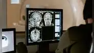 Médicos detectan cambios extraños en los cerebros de pacientes con migraña