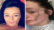 Rara enfermedad obligó a mujer a reconstruirse el rostro con grasa de su estómago