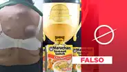 Los tumores de la foto viral no fueron causados por tomar sopa instantánea