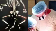 Médicos salvan la vida de un bebé que nació con tres piernas, dos genitales y sin ano [FOTOS]