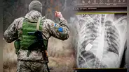 Médicos retiran una granada activa del pecho de un soldado ucraniano en riesgosa operación
