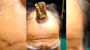 Hombre sufrió duro golpe en la cabeza y le creció un “cuerno del diablo” [FOTOS]
