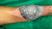 Tilapia: el pez cuya piel puede curar quemaduras y reconstruir vaginas [VIDEO]