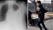 Joven de China se excedió al correr con mascarilla y termina con el pulmón colapsado