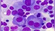 Terapia experimental logra la “remisión completa” de un tipo de cáncer en la sangre