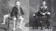 La increíble historia de Frank Lentini: ¿por qué nació con 3 piernas, 4 pies y 2 genitales?