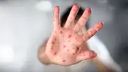 Más de 22 millones de bebés no se vacunaron contra el sarampión durante la pandemia de la Covid-19
