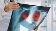 Una pastilla contra el cáncer de pulmón reduce el riesgo de muerte a la mitad, revela estudio