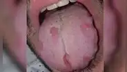 COVID-19: pacientes presentan lesiones en lengua y manchas en la piel