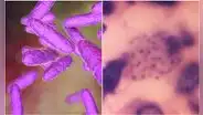 Qué se sabe de la bacteria ‘come carne’ que se transmite por vía sexual