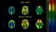 Detectan en tiempo real señales cerebrales asociadas al TOC