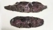 El coronavirus destruyó la placenta de mujeres infectadas y mató a sus bebés