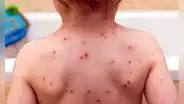 ¿Cuáles son los mitos y verdades sobre la varicela?