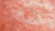 Los ácaros que habitan nuestro rostro se están fusionando con el cuerpo humano