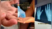 Va al traumatólogo por dolor en el dedo y se percata de negligencia médica en el seguro social