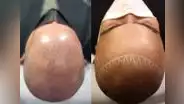 Micropigmentación capilar, una alternativa para la alopecia