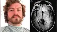 Participa en un ensayo médico para ganar dinero extra y le detectan un tumor cerebral