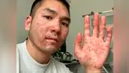 Le diagnostican sarna y herpes por error, pero en realidad tenía la viruela del mono