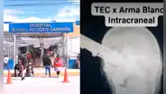 Junín: joven termina con cuchillo incrustado en el cráneo luego de pelea en fiesta
